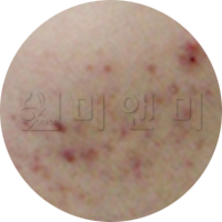 여드름 압출 후에는 사후관리가 필수적입니다 9